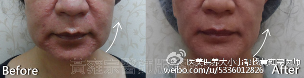 【醫學美容】膠原蛋白流失、雙下巴 、局部皺紋、臉頰鬆弛、眉尾下垂 【醫學美容】膠原蛋白流失、雙下巴 、局部皺紋、臉頰鬆弛、眉尾下垂