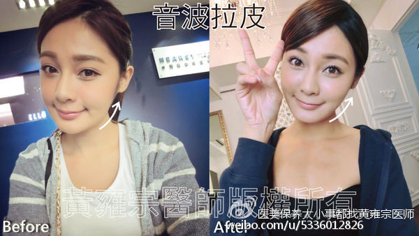 【醫學美容】膠原蛋白流失、雙下巴 、局部皺紋、臉頰鬆弛、眉尾下垂 【醫學美容】膠原蛋白流失、雙下巴 、局部皺紋、臉頰鬆弛、眉尾下垂