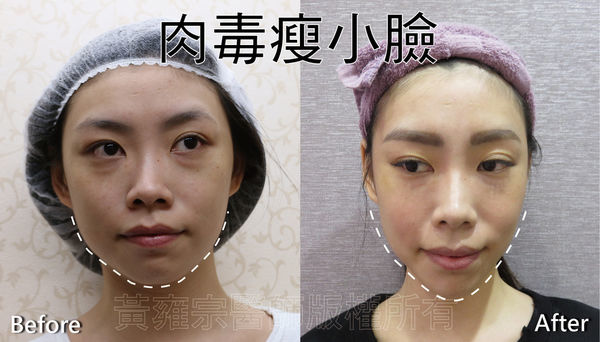 玻尿酸隆鼻-下巴-鼻樑-塌鼻子-回春-舒顏萃-肌膚水分-光澤-肉毒-臉頰寬-小V臉 玻尿酸隆鼻-下巴-鼻樑-塌鼻子-回春-舒顏萃-肌膚水分-光澤-肉毒-臉頰寬-小V臉