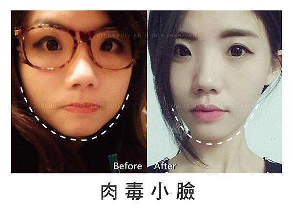 肉毒小臉01.jpg 肉毒小臉01.jpg