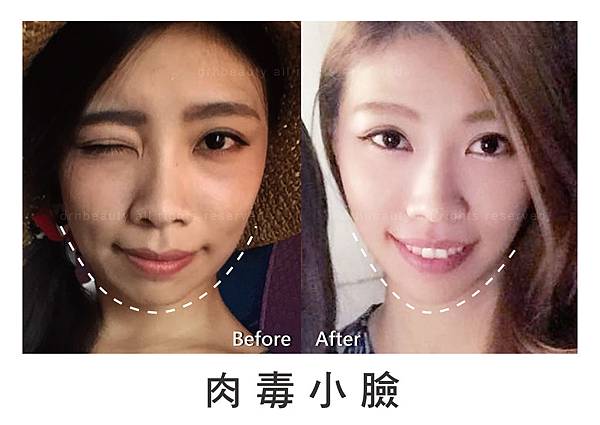 肉毒小臉02.jpg 肉毒小臉02.jpg