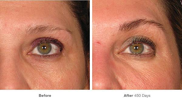 img_template_beforeafter_brow5.jpg