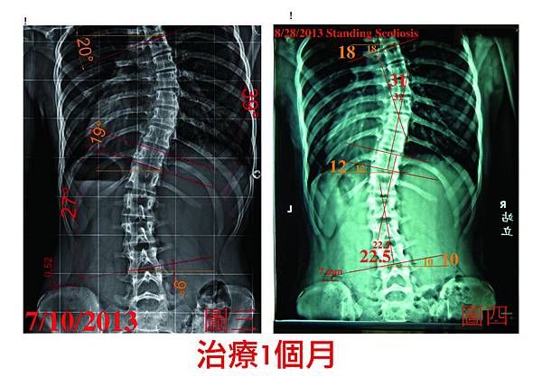 脊椎側彎case 4