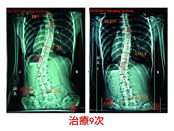 脊椎側彎case 5-02