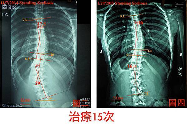 脊椎側彎case11