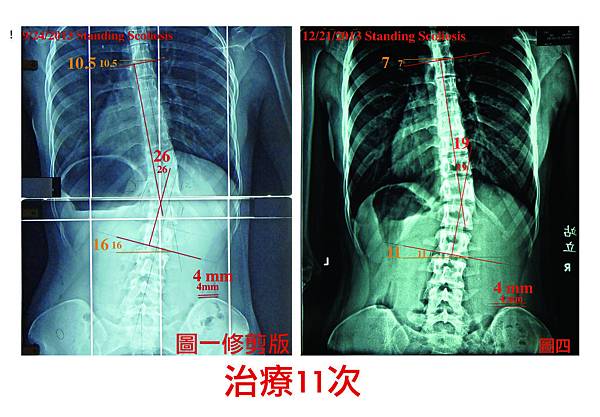 脊椎側彎case 9-02