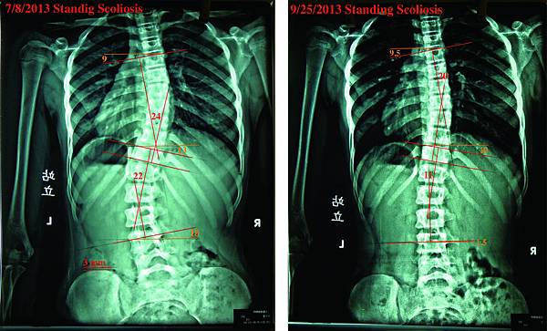 脊椎側彎case 3.jpg
