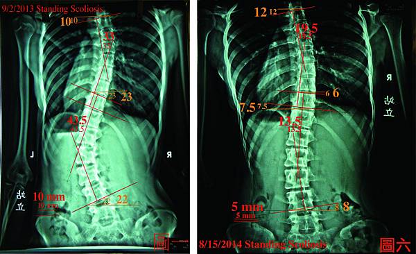 脊椎側彎case 5.jpg