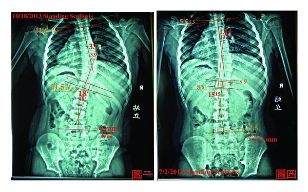 脊椎側彎case 8.jpg