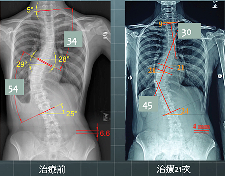 scoliosis T%5Cx 5.png