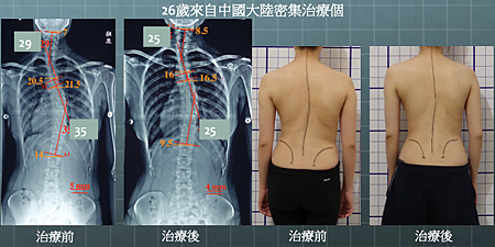 scoliosis T%5Cx result 4.png