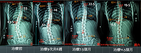 scoliosis T%5Cx result 1.png