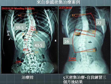 scoliosis T%5Cx result 3.png