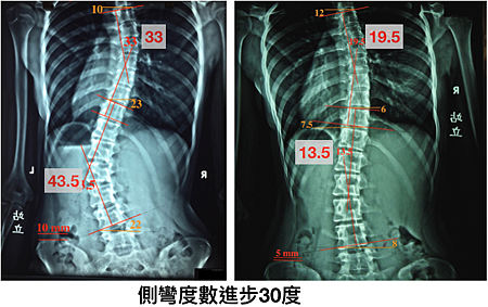 scoliosis curve reduction 30 degree.png scoliosis curve reduction 30 degree.png