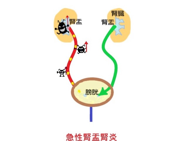 Dr 闕來解答 急性腎盂腎炎 Apn 也是最常見的上泌尿道感染之一 Dr 闕來解答 大同醫院泌尿科醫師闕光瞬 痞客邦