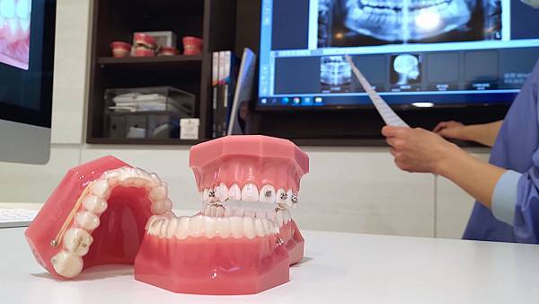 各類矯正器 各類矯正器