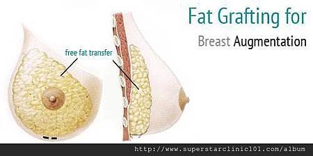 fat graft-47 fat graft-47