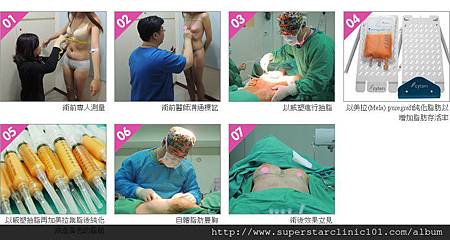 威塑美拉自體脂肪隆乳 威塑美拉自體脂肪隆乳