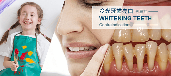 teeth-whitening-side-effects-drmin.png