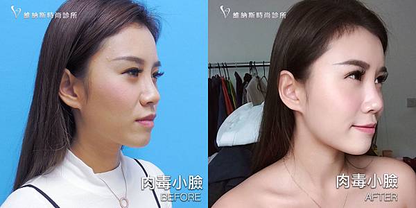 肉毒1008-4.jpg 肉毒1008-4.jpg