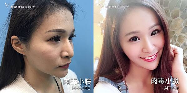 肉毒1008-5.jpg 肉毒1008-5.jpg