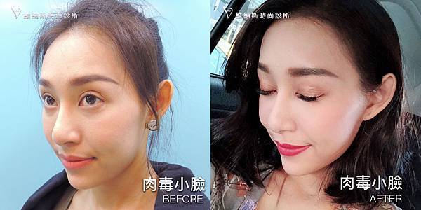 肉毒1008-3.jpg 肉毒1008-3.jpg