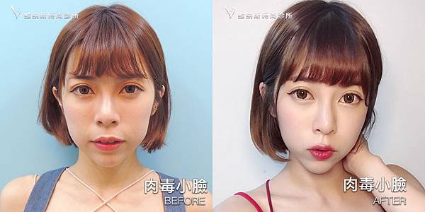 肉毒1008-2.jpg 肉毒1008-2.jpg