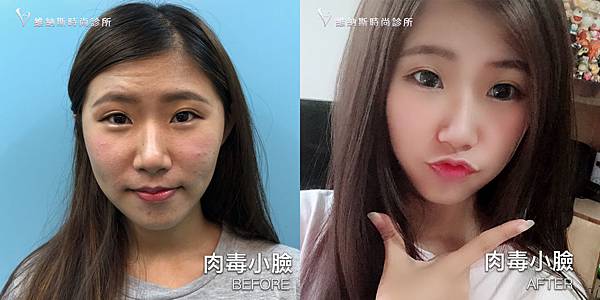 肉毒1008-1.jpg 肉毒1008-1.jpg