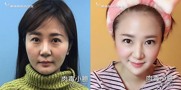 肉毒1008-6.jpg 肉毒1008-6.jpg