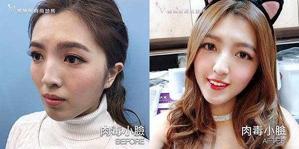 肉毒1008-8.jpg 肉毒1008-8.jpg