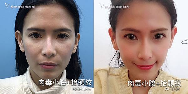 肉毒1008-7.jpg 肉毒1008-7.jpg