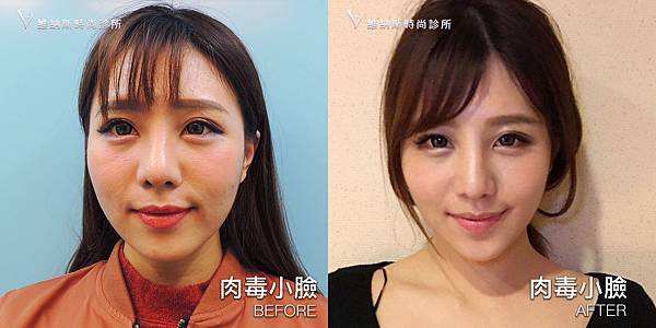 肉毒1008-11.jpg 肉毒1008-11.jpg