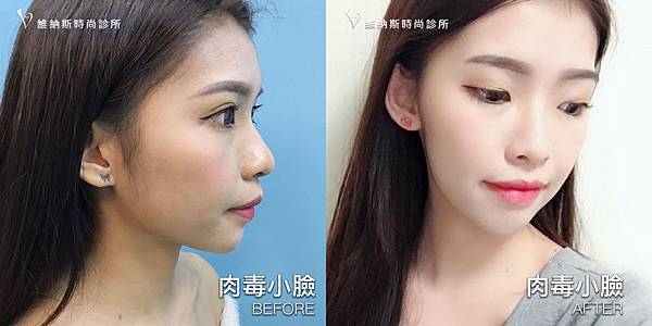 肉毒1008-9.jpg 肉毒1008-9.jpg