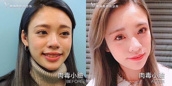 肉毒1008-12.jpg 肉毒1008-12.jpg