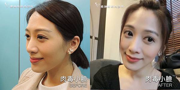 肉毒1008-13.jpg 肉毒1008-13.jpg