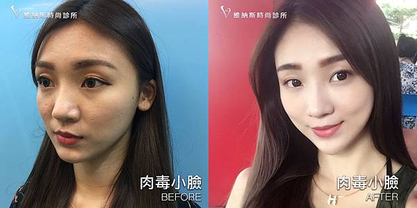 肉毒1008-15.jpg 肉毒1008-15.jpg