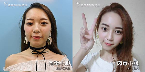 肉毒1008-14.jpg 肉毒1008-14.jpg