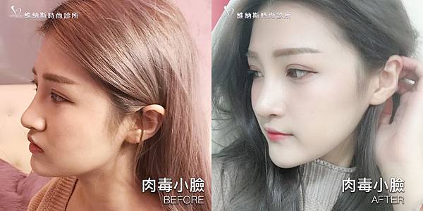 肉毒1008-16.jpg 肉毒1008-16.jpg