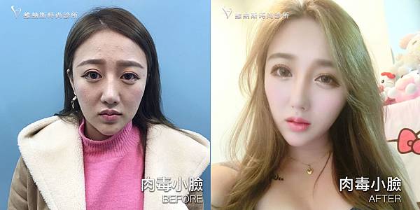 肉毒1008-18.jpg 肉毒1008-18.jpg