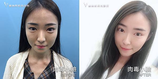 肉毒1008-17.jpg 肉毒1008-17.jpg