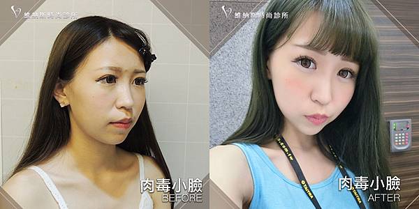 肉毒1008-20.jpg 肉毒1008-20.jpg