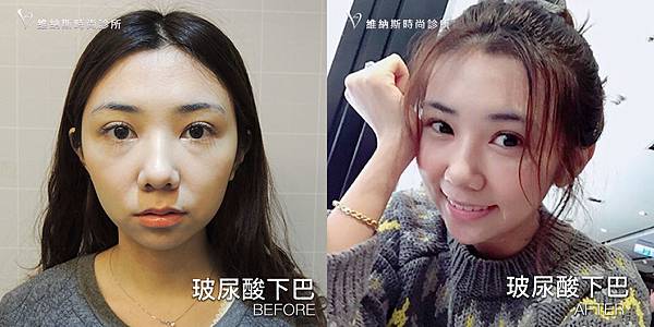 玻尿酸下巴1008-23.jpg 玻尿酸下巴1008-23.jpg