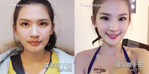 玻尿酸下巴1008-22.jpg 玻尿酸下巴1008-22.jpg