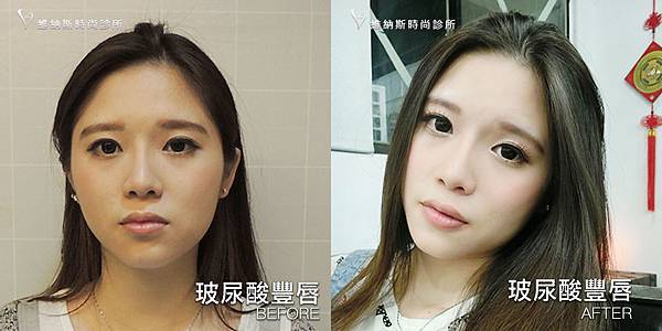 玻尿酸豐唇1008-22.jpg 玻尿酸豐唇1008-22.jpg