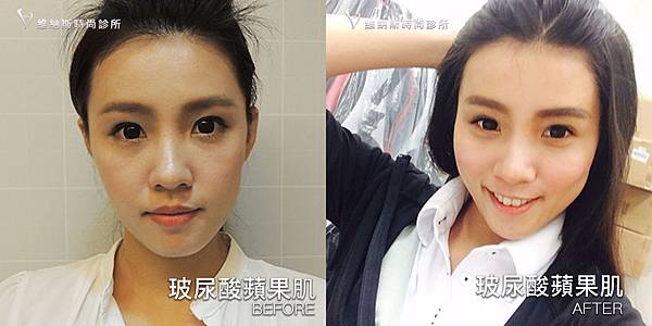 玻尿酸蘋果肌1008-21.jpg 玻尿酸蘋果肌1008-21.jpg