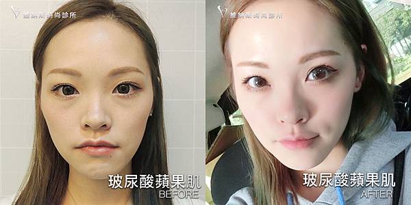 玻尿酸蘋果肌1008-24.jpg 玻尿酸蘋果肌1008-24.jpg