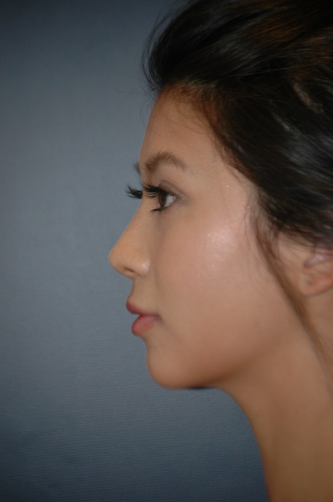 side profile after.jpg side profile after.jpg