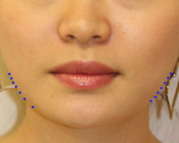 botox-front-dots-aft.jpg botox-front-dots-aft.jpg