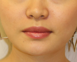 botox-front-aft.jpg botox-front-aft.jpg