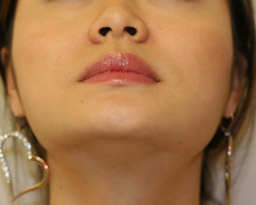botox-baseview-aft.jpg botox-baseview-aft.jpg